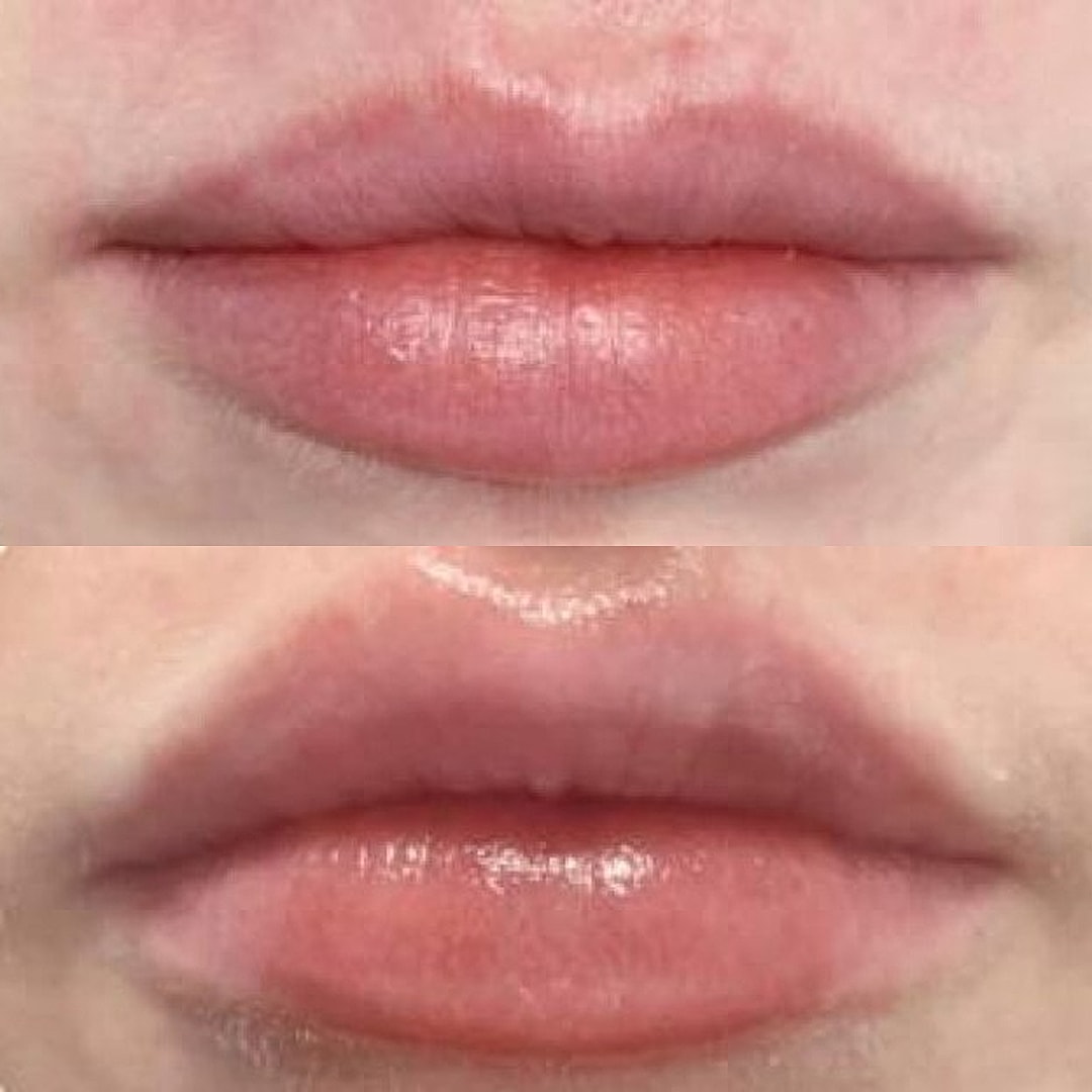 Lip Filler Before & After