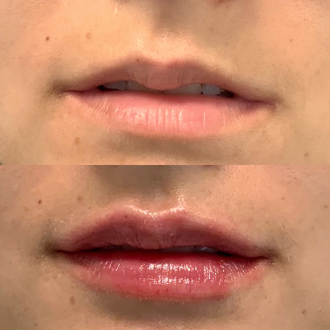 Lip Filler Before & After