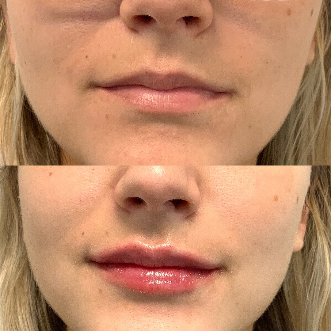 Lip Filler Before & After