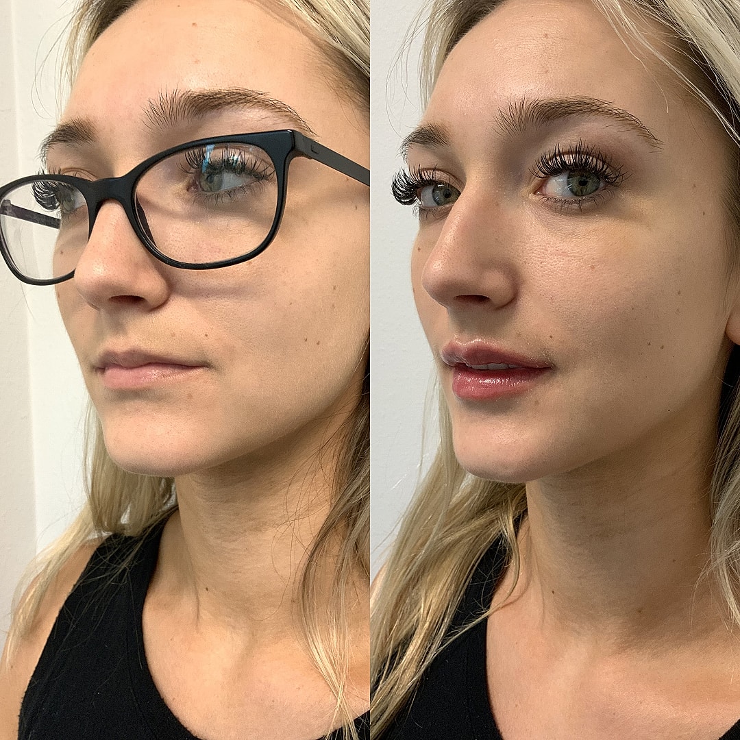 Lip Filler Before & After