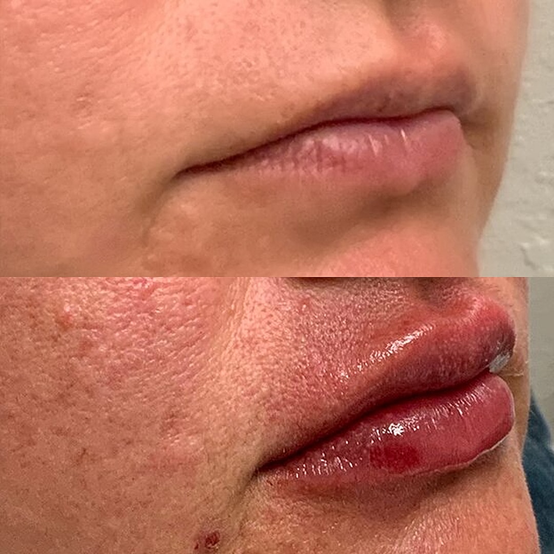 Lip Filler Before & After