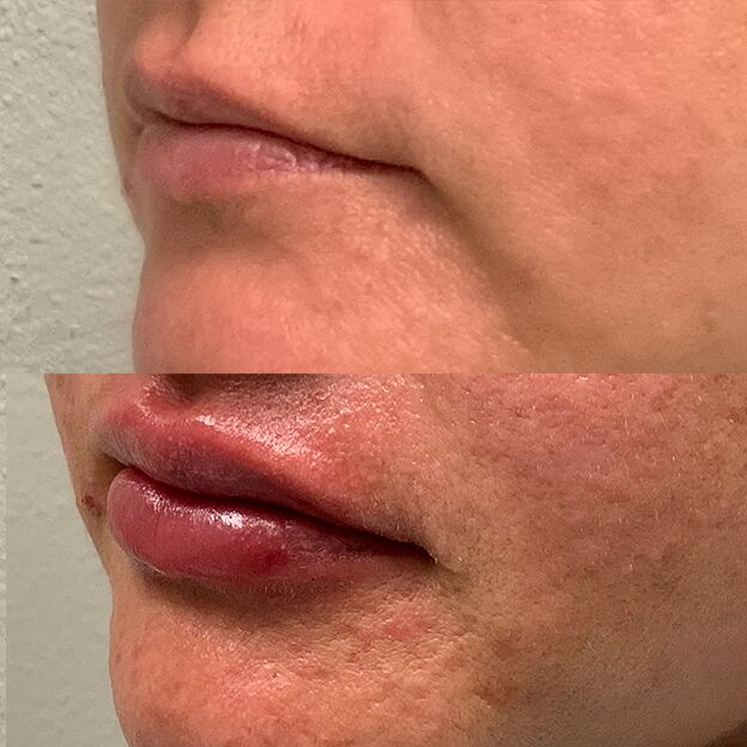 Lip Filler Before & After