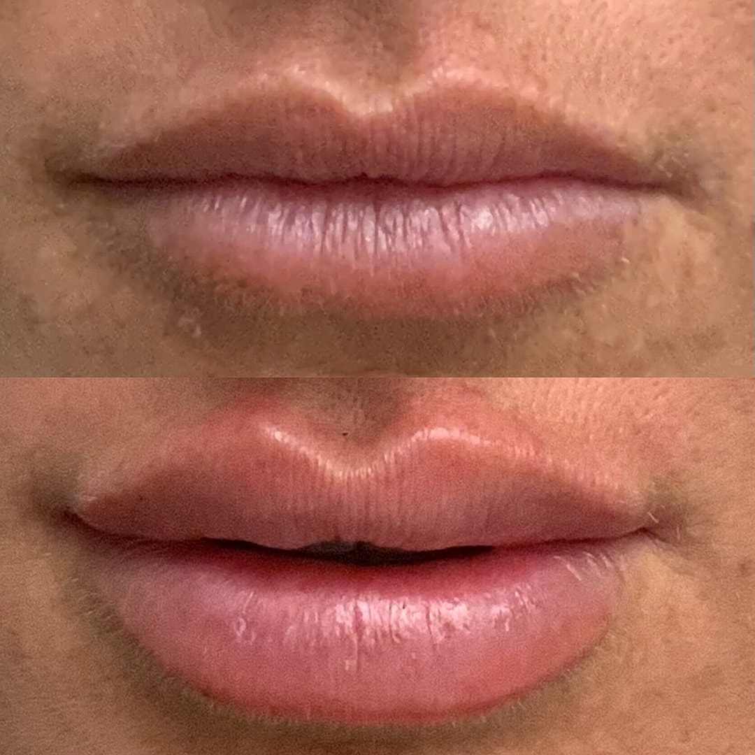 Lip Filler Before & After