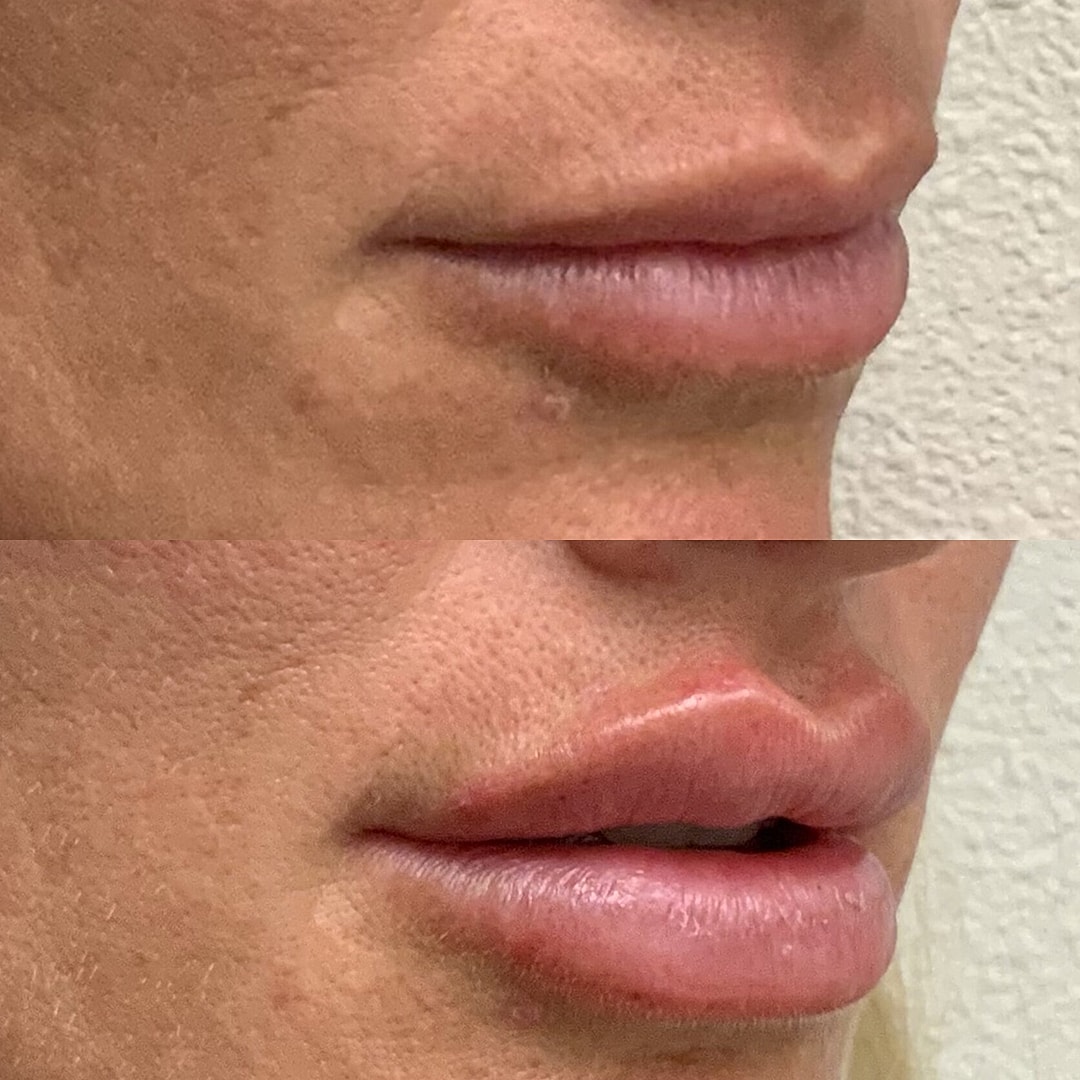 Lip Filler Before & After