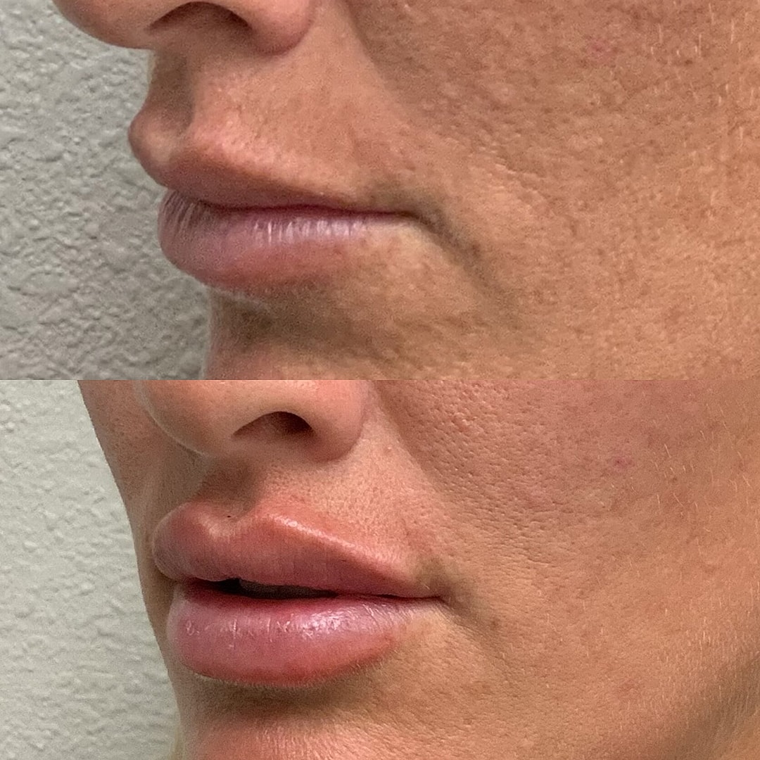 Lip Filler Before & After