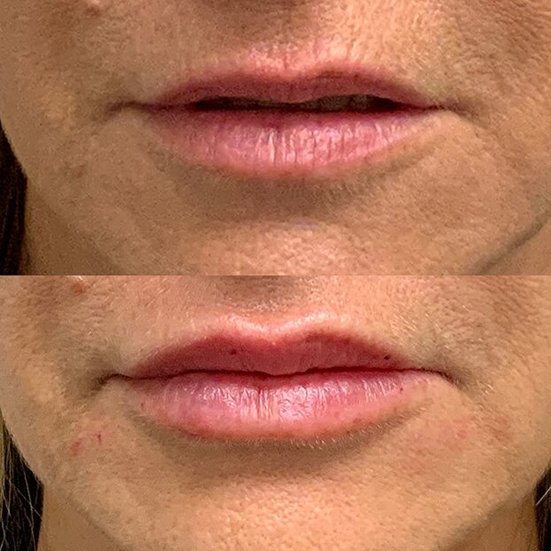 Lip Filler Before & After