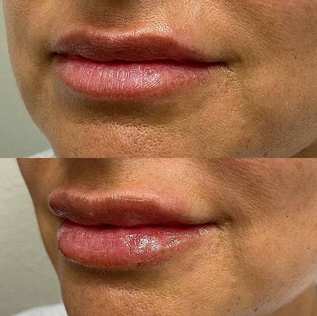Lip Filler Before & After