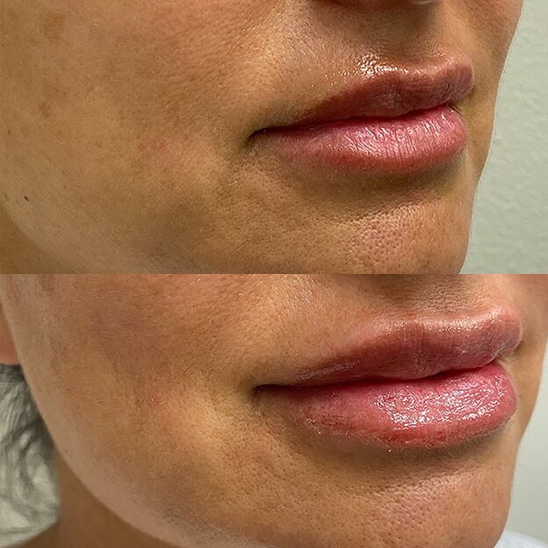 Lip Filler Before & After