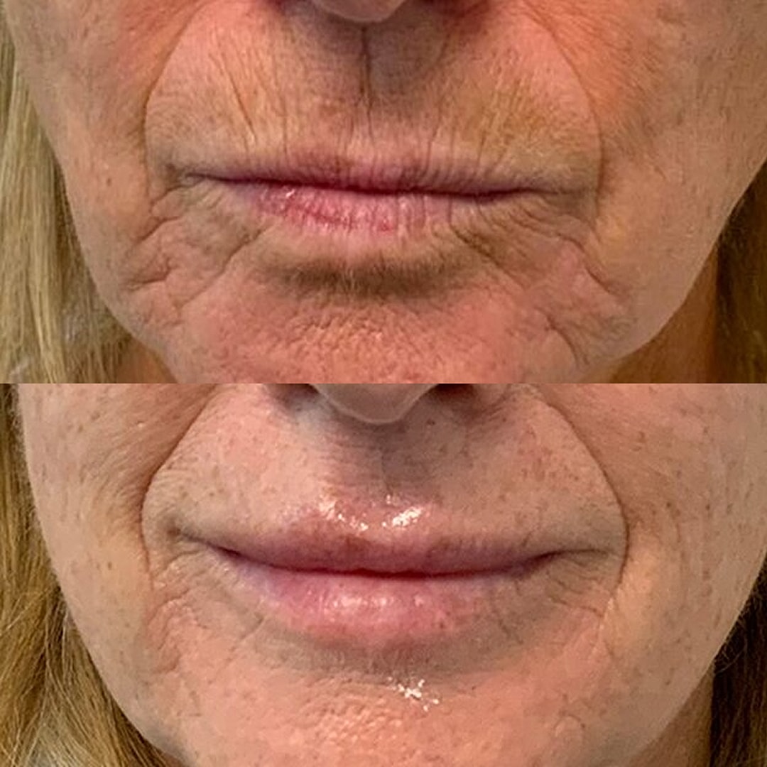 Lip Filler Before & After