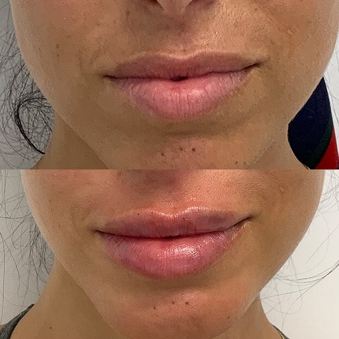 Lip Filler Before & After