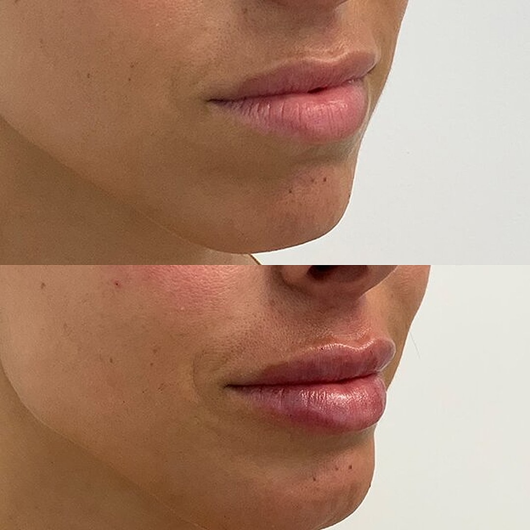 Lip Filler Before & After