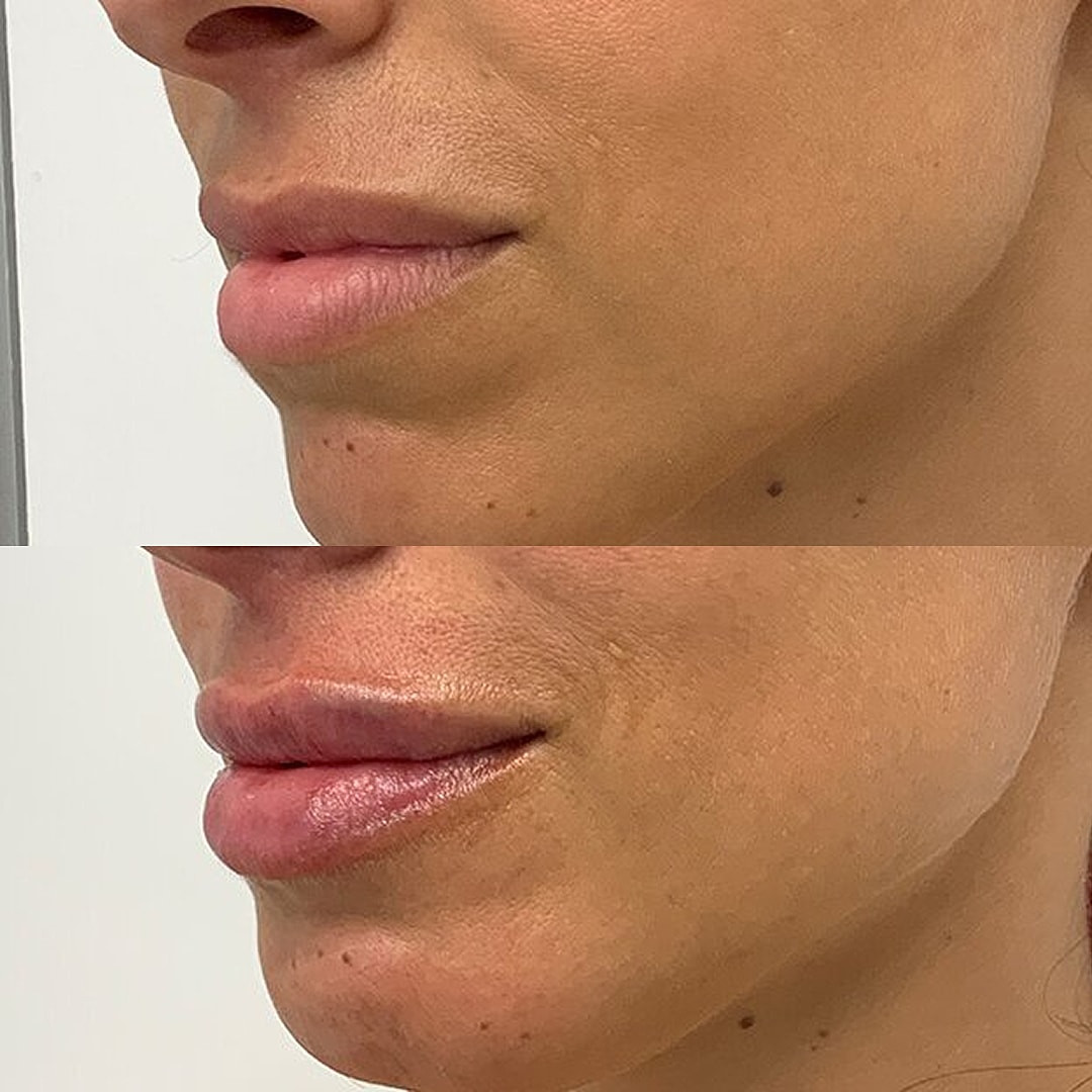 Lip Filler Before & After