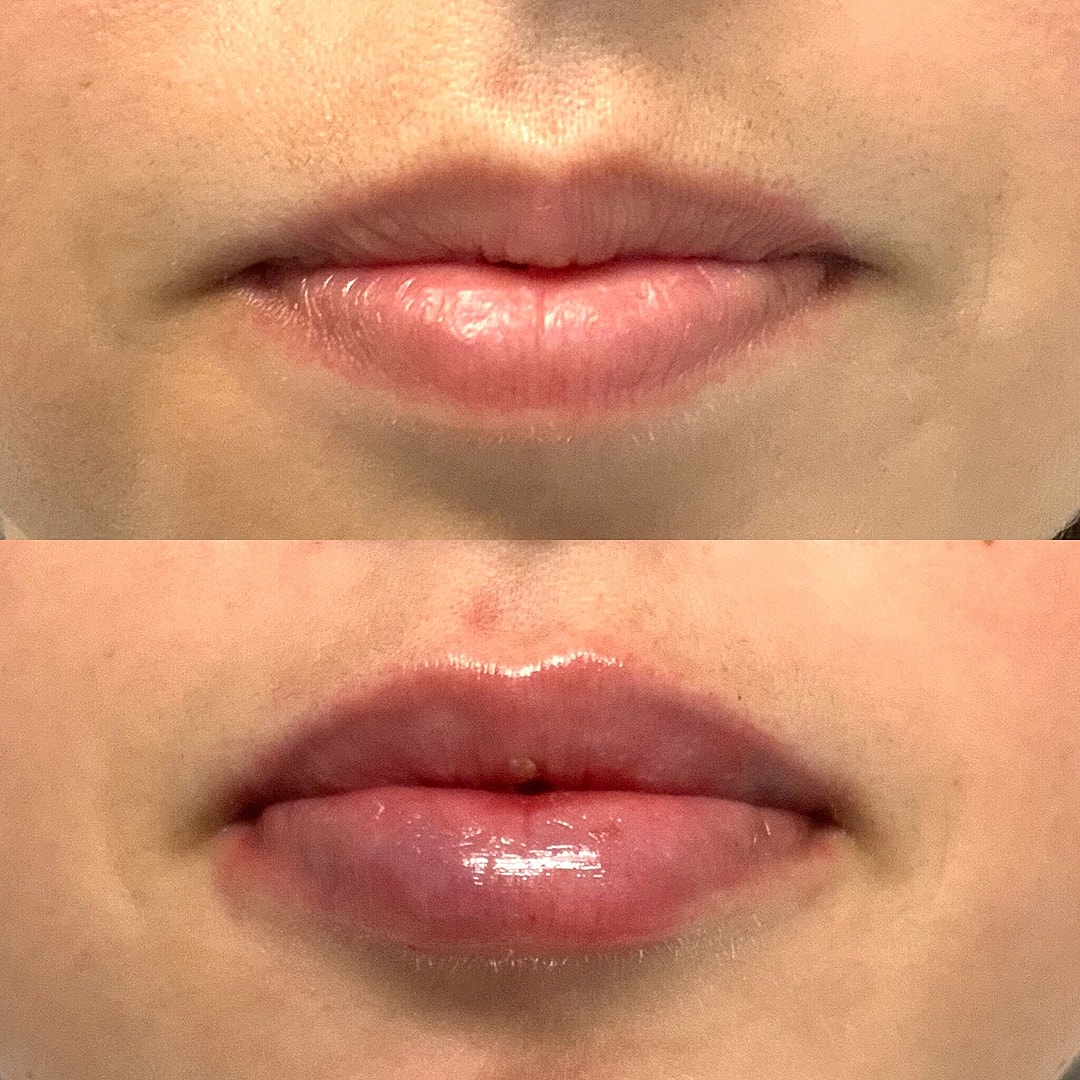 Lip Filler Before & After