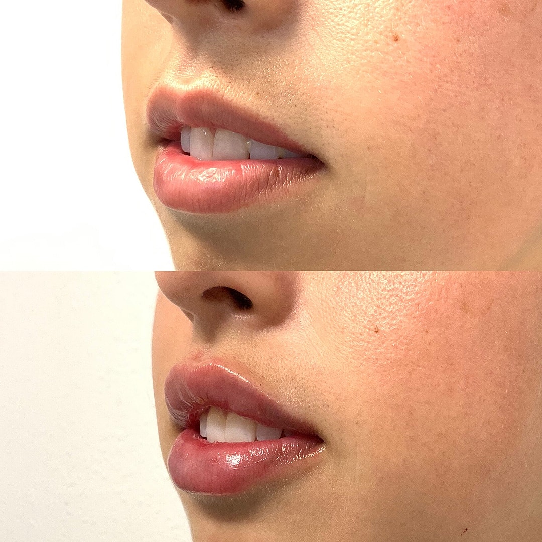 Lip Filler Before & After