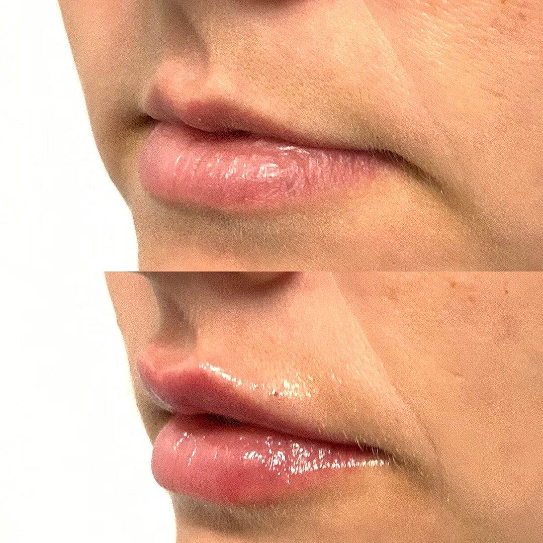 Lip Filler Before & After
