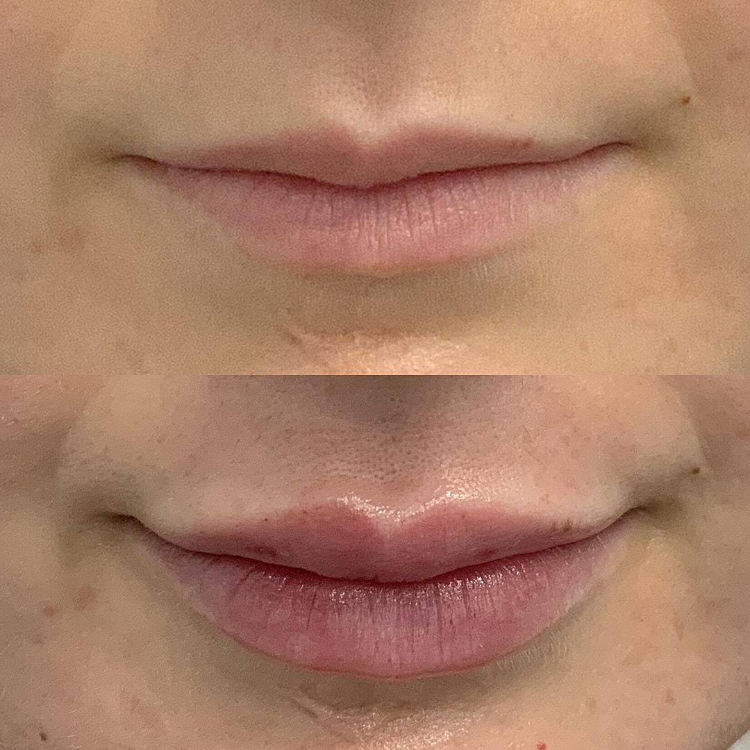 Lip Filler Before & After