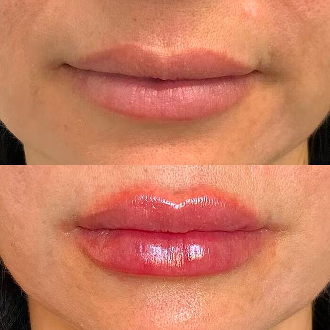 Lip Filler Before & After