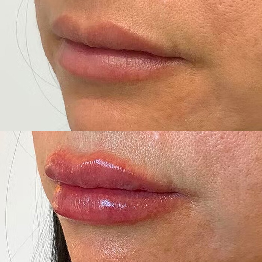 Lip Filler Before & After