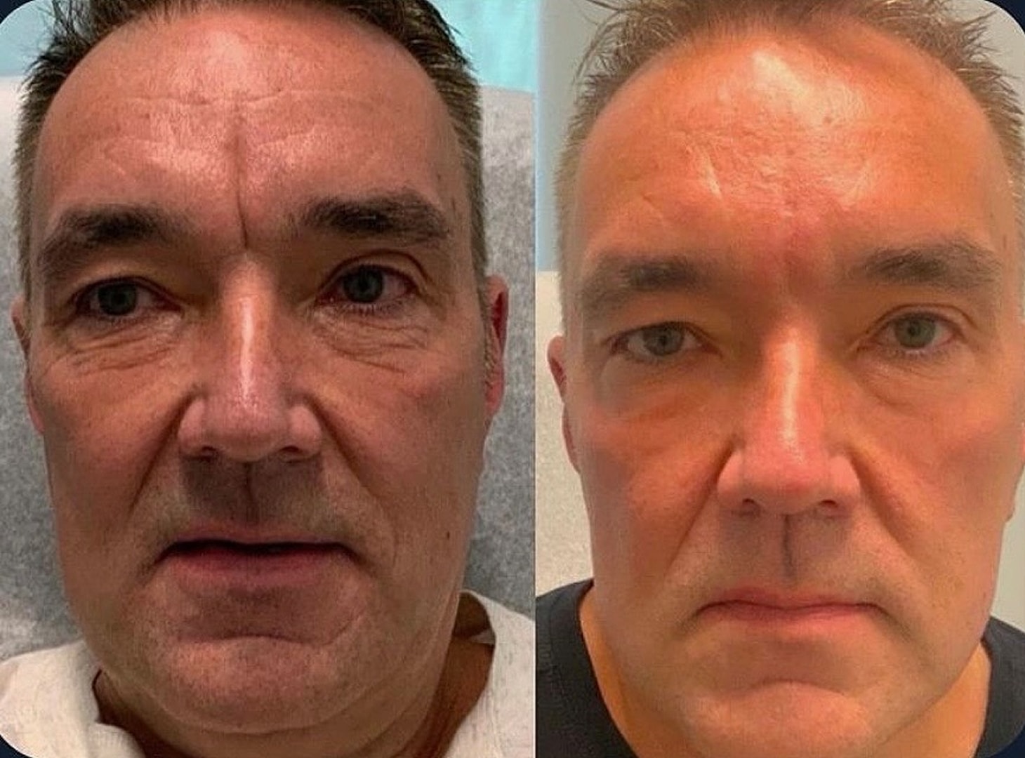 Vivace Microneedling Before & After