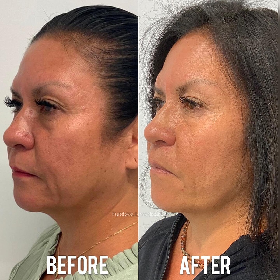 Vivace Microneedling Before & After