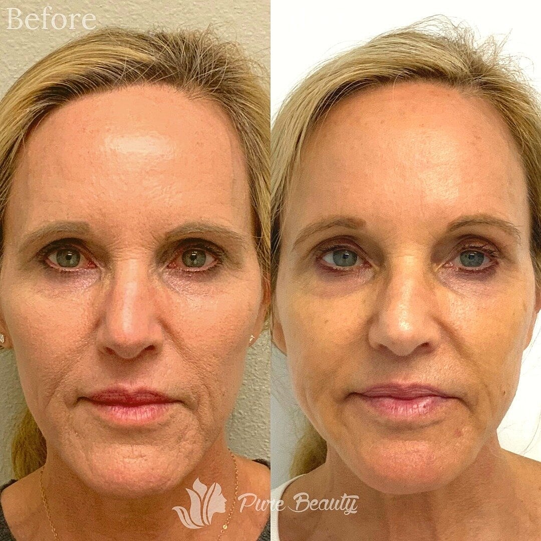 Vivace Microneedling Before & After