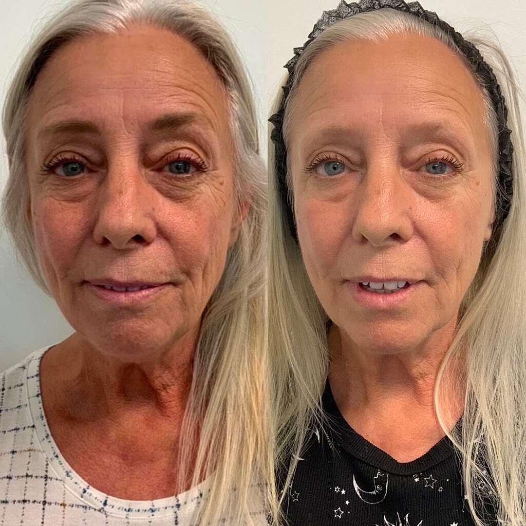 Vivace Microneedling Before & After
