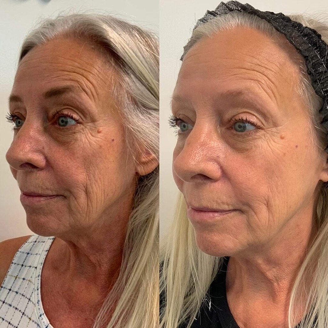 Vivace Microneedling Before & After