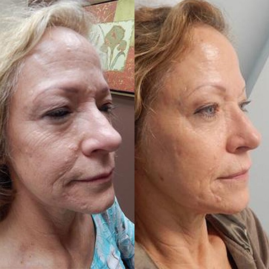 Vivace Microneedling Before & After