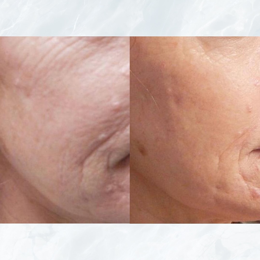 Vivace Microneedling Before & After