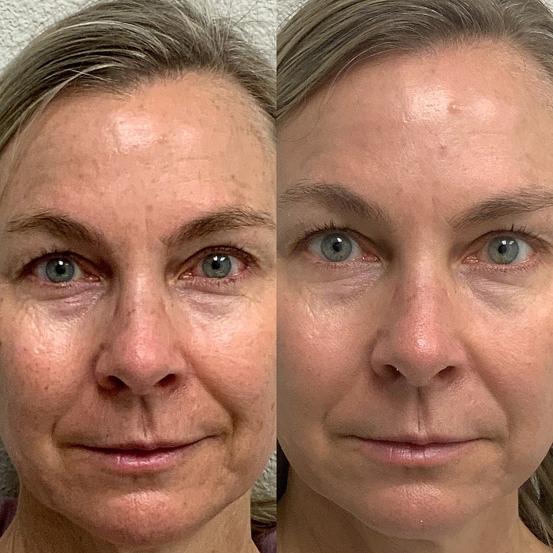 Vivace Microneedling Before & After