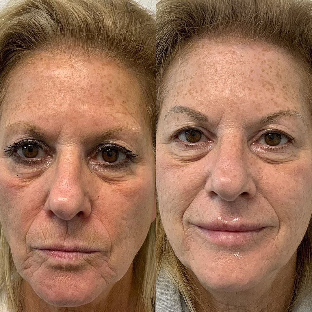 Vivace Microneedling Before & After