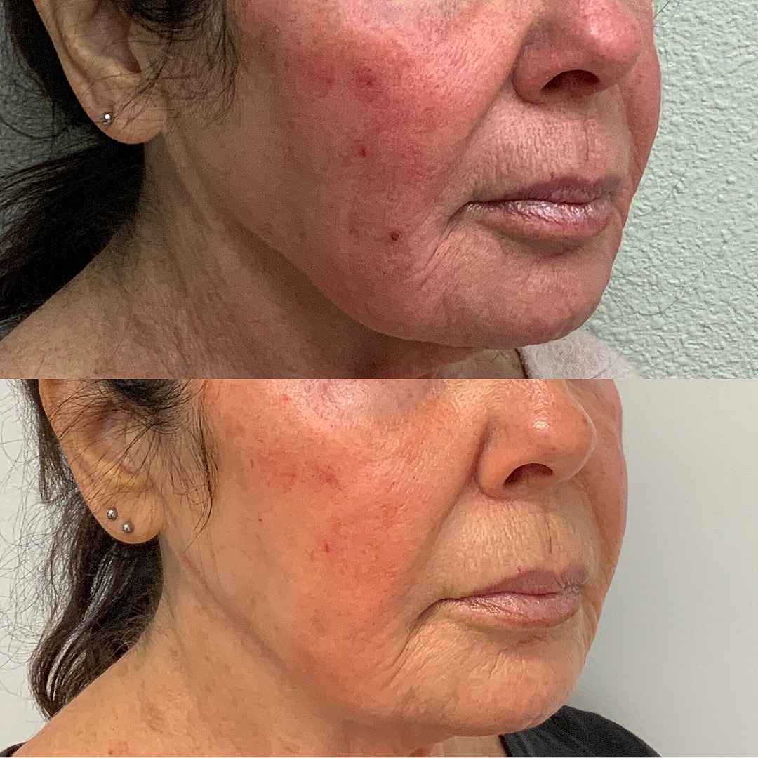 Vivace Microneedling Before & After