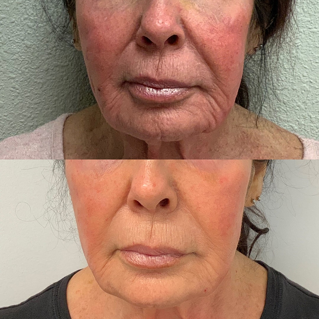 Vivace Microneedling Before & After