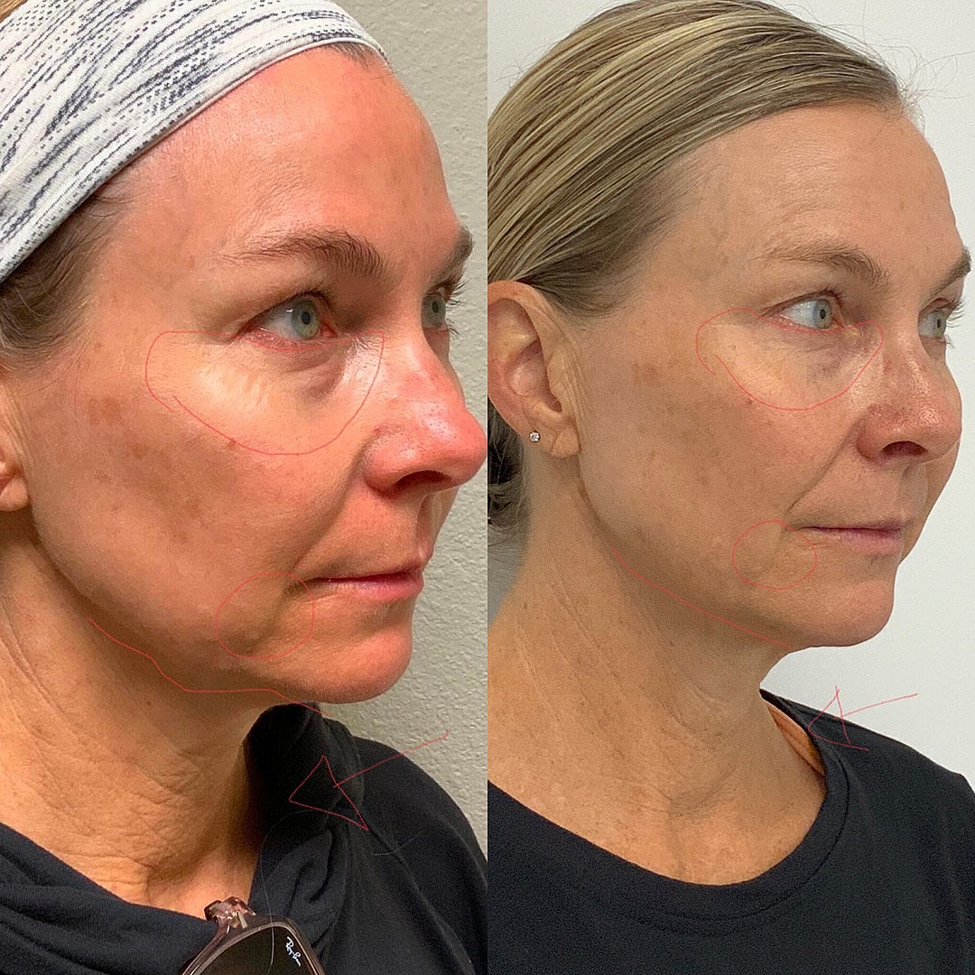 Vivace Microneedling Before & After