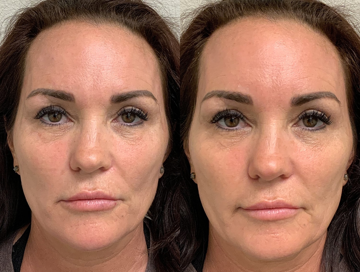 Liquid Facelift Before & After