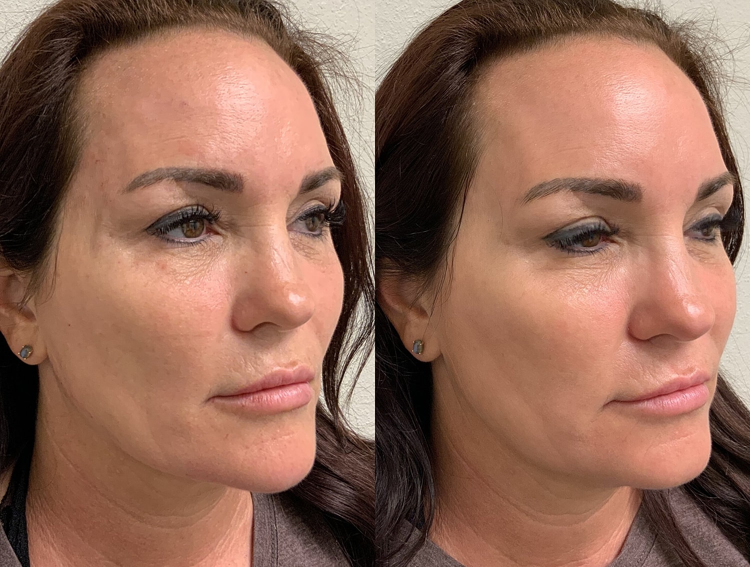 Liquid Facelift Before & After