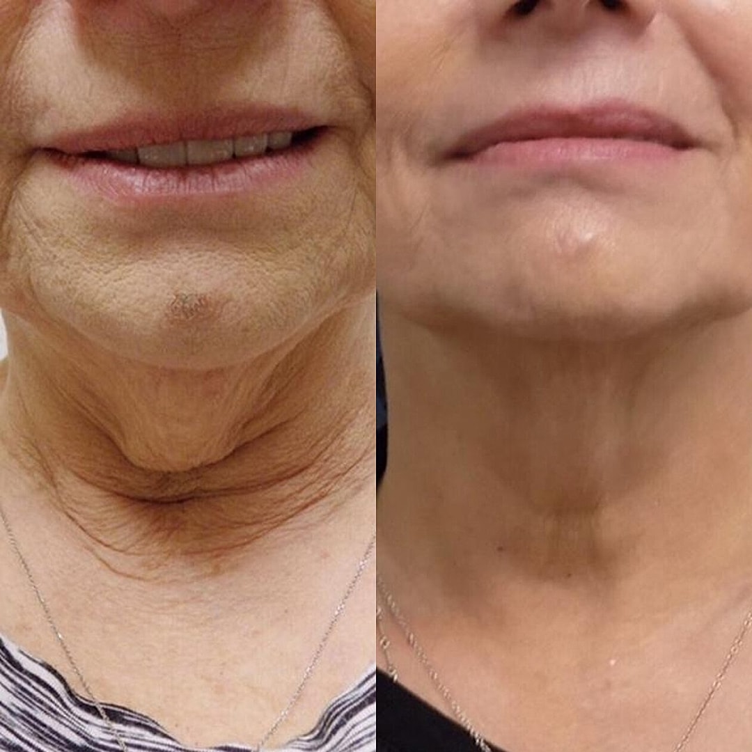 Kybella Before & After