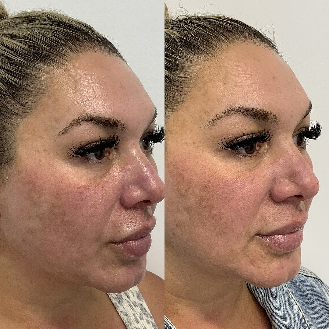 Hydrafacial Before & After