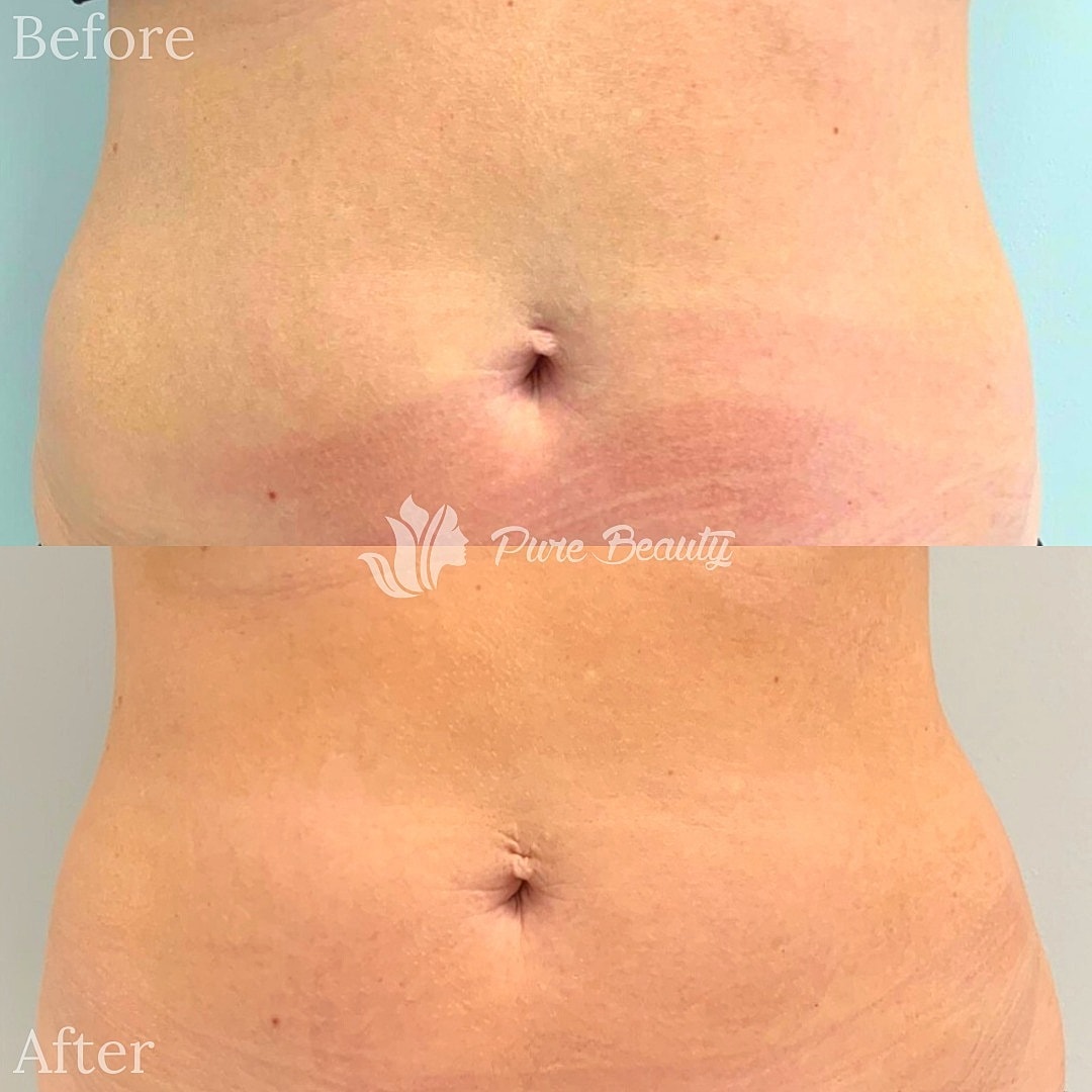 Trusculpt Id Before & After