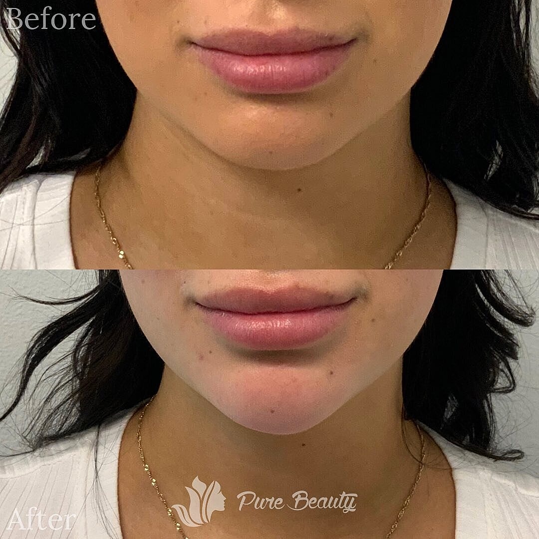 Dermal Fillers Before & After
