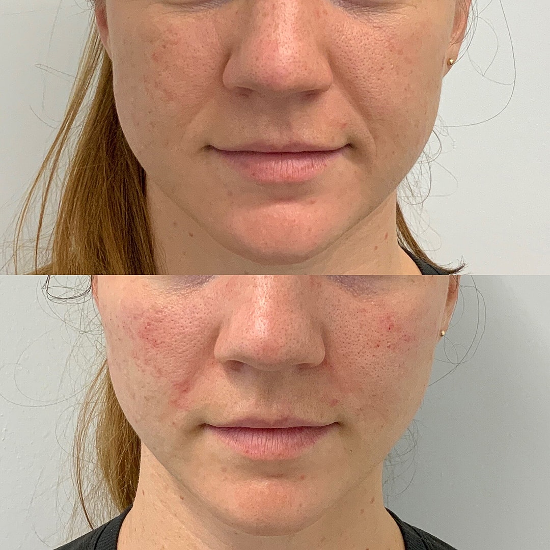 Dermal Fillers Before & After